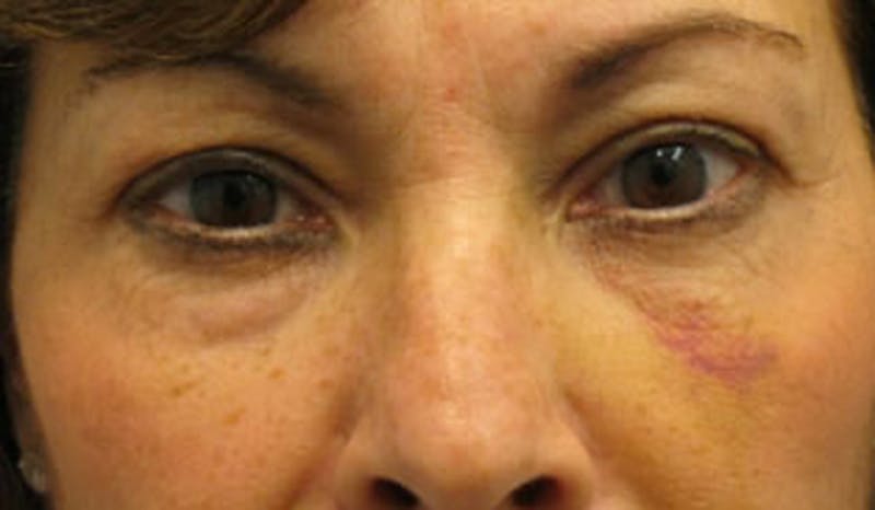 Eyelid Surgery Before & After Gallery - Patient 174146413 - Image 1