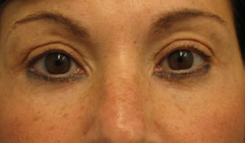 Eyelid Surgery Before & After Gallery - Patient 174146413 - Image 2