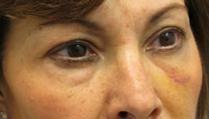 Eyelid Surgery Before & After Gallery - Patient 174146413 - Image 3