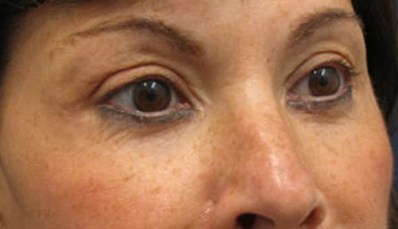 Eyelid Surgery Before & After Gallery - Patient 174146413 - Image 4