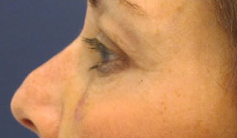 Eyelid Surgery Before & After Gallery - Patient 174146413 - Image 5