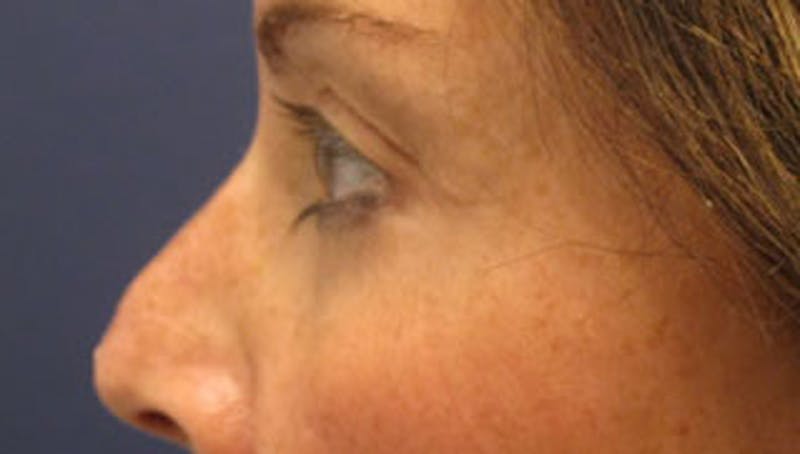 Eyelid Surgery Before & After Gallery - Patient 174146413 - Image 6