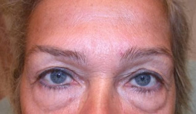 Eyelid Surgery Before & After Gallery - Patient 174146415 - Image 1