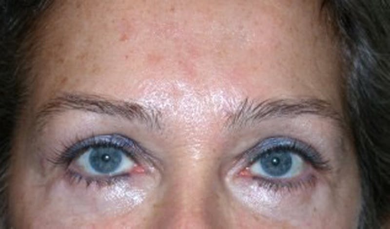 Eyelid Surgery Before & After Gallery - Patient 174146415 - Image 2