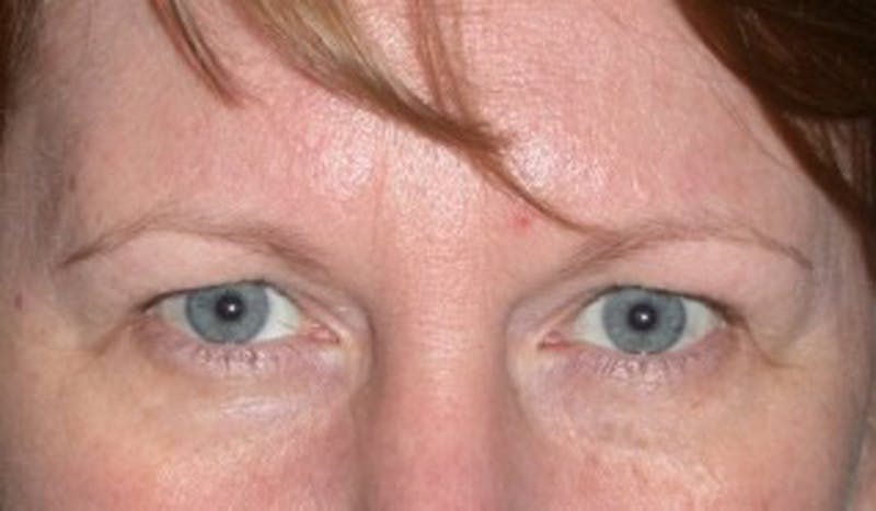 Eyelid Surgery Before & After Gallery - Patient 174146419 - Image 1