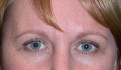 Eyelid Surgery Before & After Gallery - Patient 174146419 - Image 2