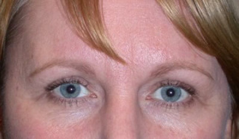Eyelid Surgery Before & After Gallery - Patient 174146419 - Image 2