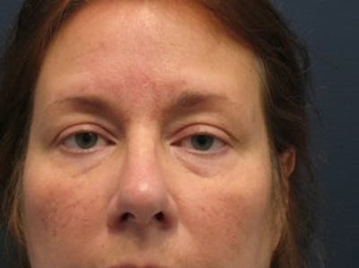 Eyelid Surgery Before & After Gallery - Patient 174146420 - Image 1
