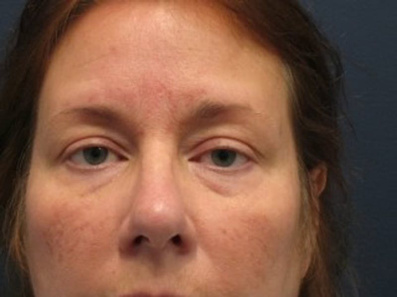 Eyelid Surgery Before & After Gallery - Patient 174146420 - Image 1