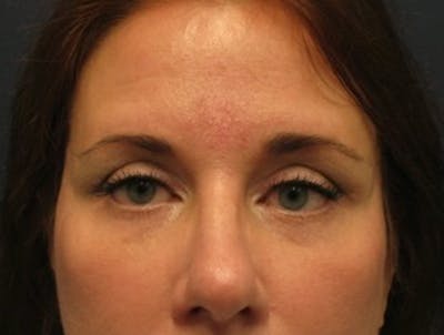 Eyelid Surgery Before & After Gallery - Patient 174146420 - Image 2