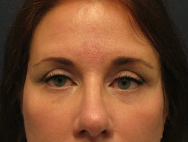 Eyelid Surgery Before & After Gallery - Patient 174146420 - Image 2