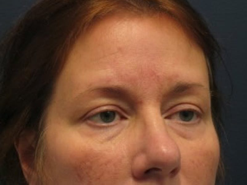 Eyelid Surgery Before & After Gallery - Patient 174146420 - Image 3