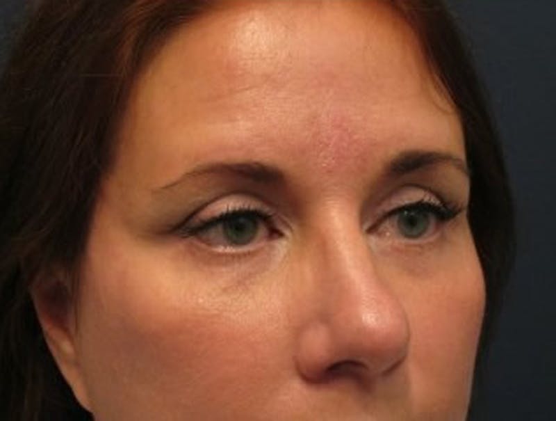 Eyelid Surgery Before & After Gallery - Patient 174146420 - Image 4