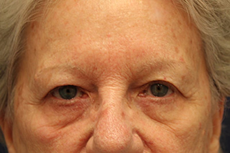 Eyelid Surgery Before & After Gallery - Patient 174146422 - Image 1