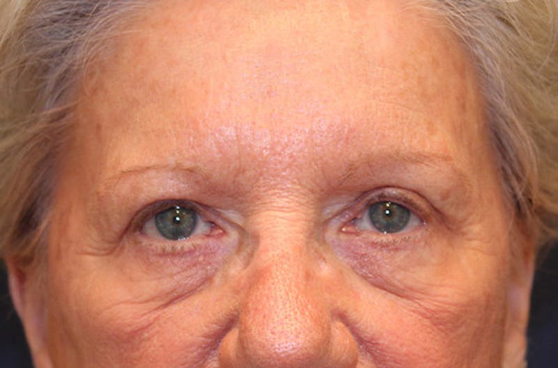 Eyelid Surgery Before & After Gallery - Patient 174146422 - Image 2