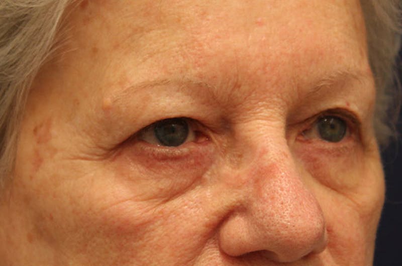 Eyelid Surgery Before & After Gallery - Patient 174146422 - Image 3
