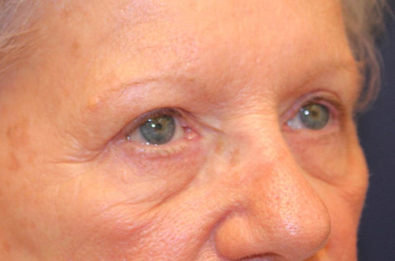 Eyelid Surgery Before & After Gallery - Patient 174146422 - Image 4