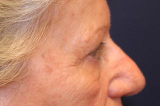 Eyelid Surgery Before & After Gallery - Patient 174146422 - Image 6