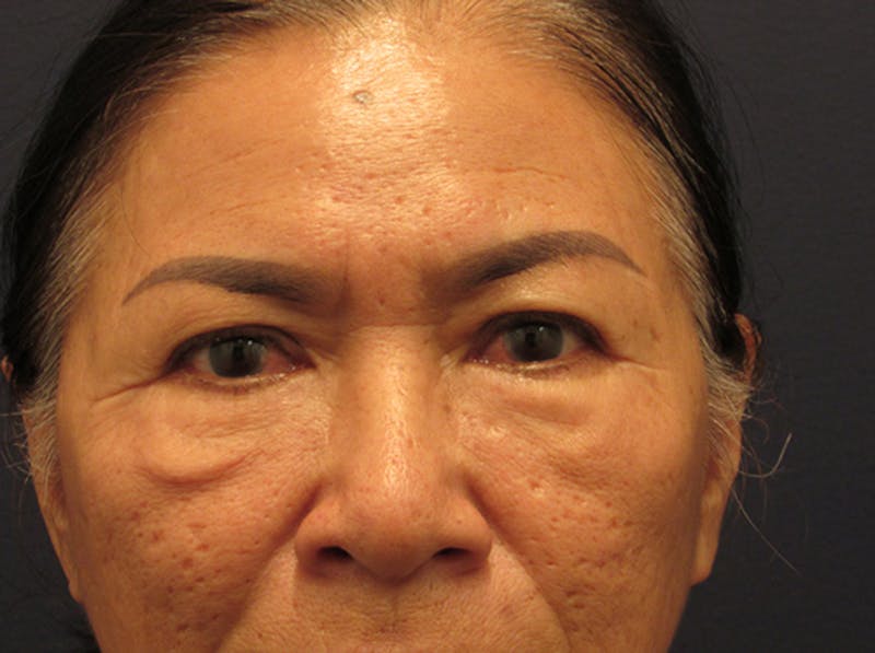 Eyelid Surgery Before & After Gallery - Patient 174146424 - Image 1