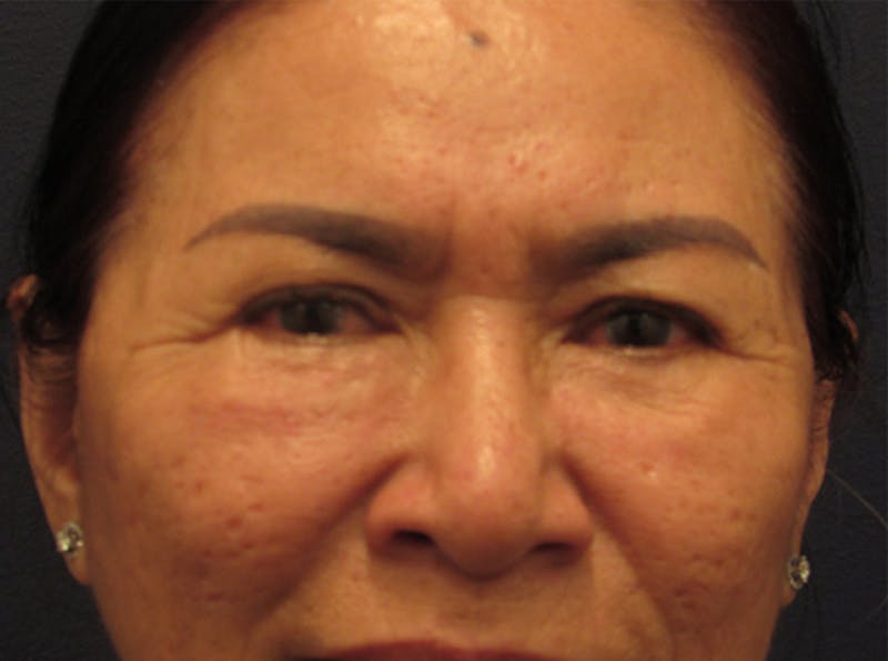 Eyelid Surgery Before & After Gallery - Patient 174146424 - Image 2