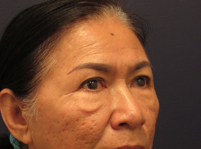 Eyelid Surgery Before & After Gallery - Patient 174146424 - Image 3