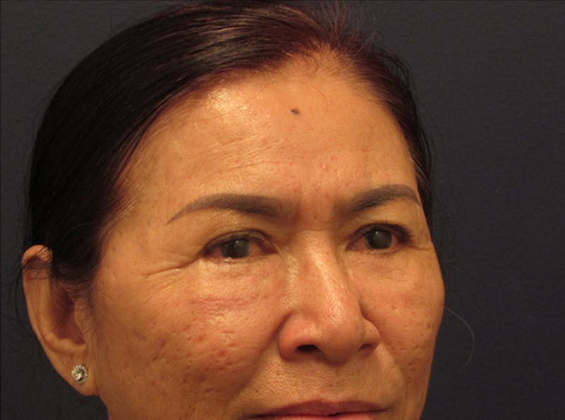 Eyelid Surgery Before & After Gallery - Patient 174146424 - Image 4