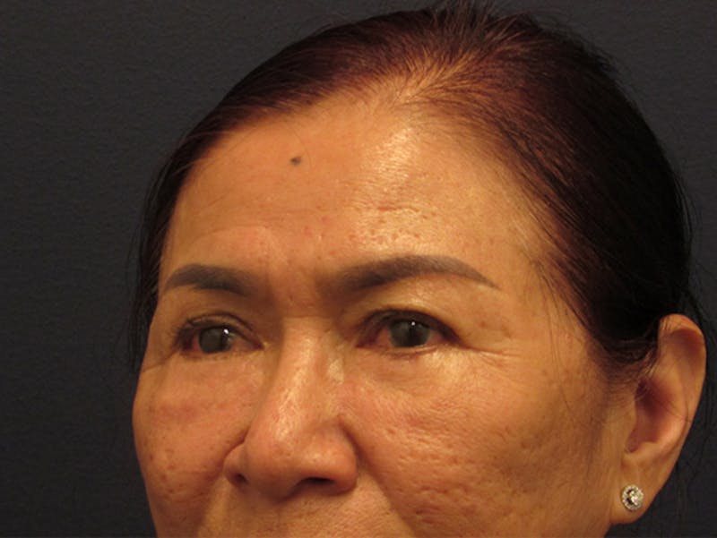 Eyelid Surgery Before & After Gallery - Patient 174146424 - Image 6