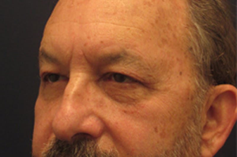 Eyelid Surgery Before & After Gallery - Patient 174146427 - Image 4