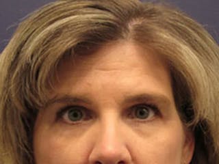 Eyelid Surgery Before & After Gallery - Patient 174146431 - Image 2