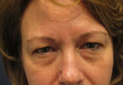 Eyelid Surgery Before & After Gallery - Patient 174146434 - Image 1