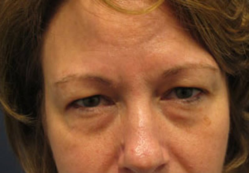 Eyelid Surgery Before & After Gallery - Patient 174146434 - Image 1