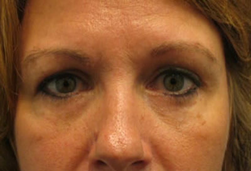Eyelid Surgery Before & After Gallery - Patient 174146434 - Image 2