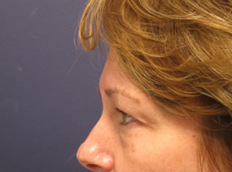 Eyelid Surgery Before & After Gallery - Patient 174146434 - Image 3