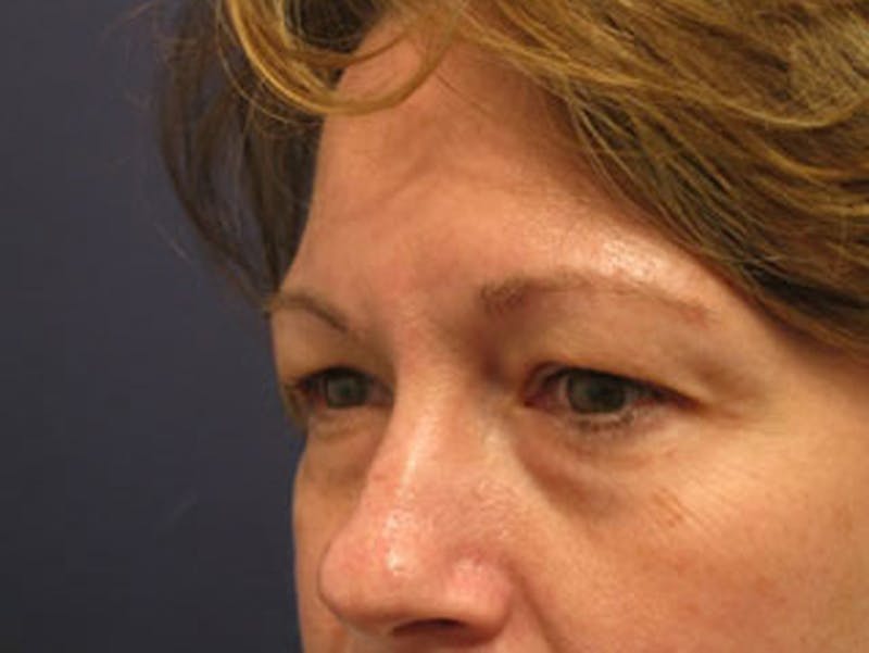 Eyelid Surgery Before & After Gallery - Patient 174146434 - Image 5