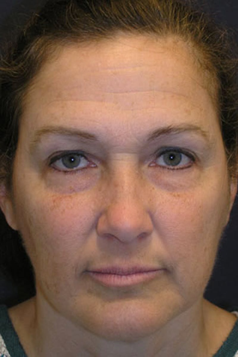 Eyelid Surgery Before & After Gallery - Patient 174146436 - Image 1