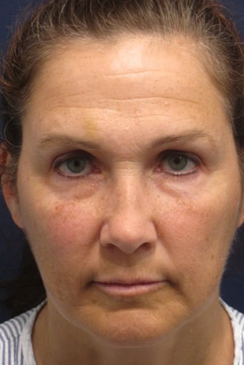 Eyelid Surgery Before & After Gallery - Patient 174146436 - Image 2