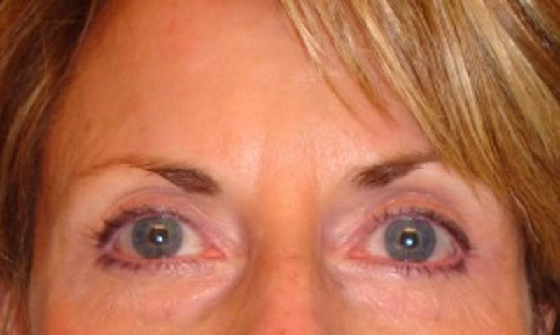 Eyelid Surgery Before & After Gallery - Patient 174146439 - Image 2