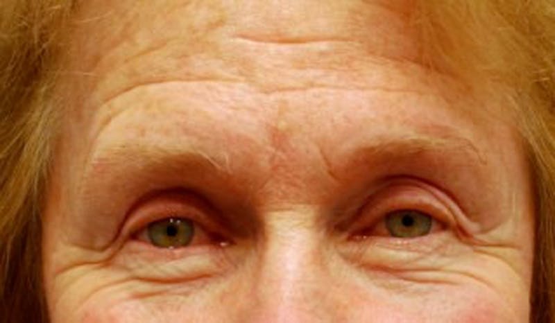 Eyelid Surgery Before & After Gallery - Patient 174146440 - Image 1