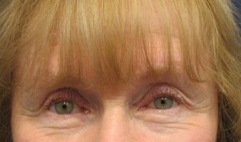 Eyelid Surgery Before & After Gallery - Patient 174146440 - Image 2