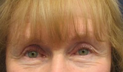 Eyelid Surgery Before & After Gallery - Patient 174146440 - Image 2