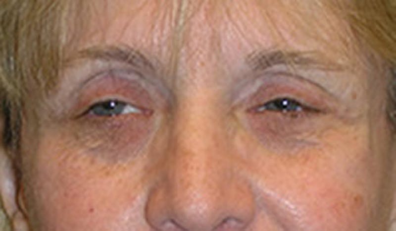 Eyelid Surgery Before & After Gallery - Patient 174146443 - Image 2