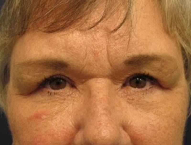 Eyelid Surgery Before & After Gallery - Patient 174146446 - Image 2