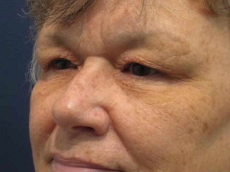 Eyelid Surgery Before & After Gallery - Patient 174146446 - Image 3