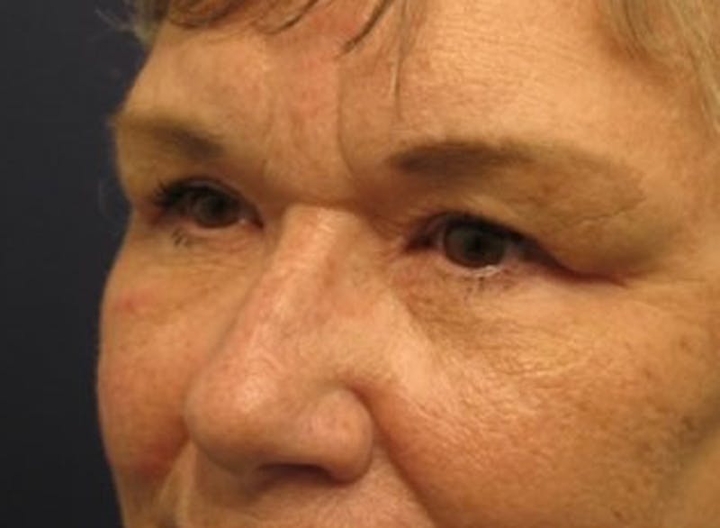 Eyelid Surgery Before & After Gallery - Patient 174146446 - Image 4