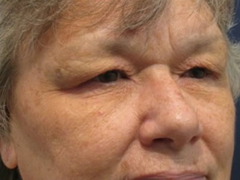 Eyelid Surgery Before & After Gallery - Patient 174146446 - Image 5