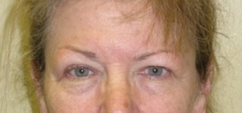Eyelid Surgery Before & After Gallery - Patient 174146449 - Image 1