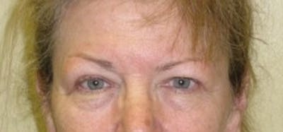 Eyelid Surgery Before & After Gallery - Patient 174146449 - Image 1