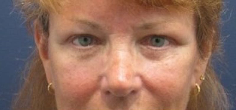 Eyelid Surgery Before & After Gallery - Patient 174146449 - Image 2