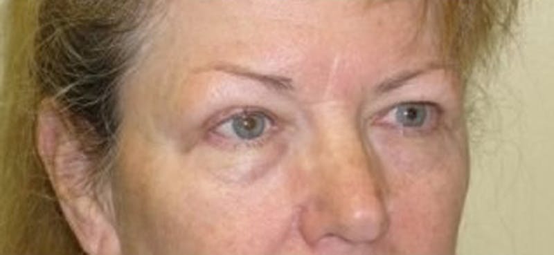 Eyelid Surgery Before & After Gallery - Patient 174146449 - Image 3