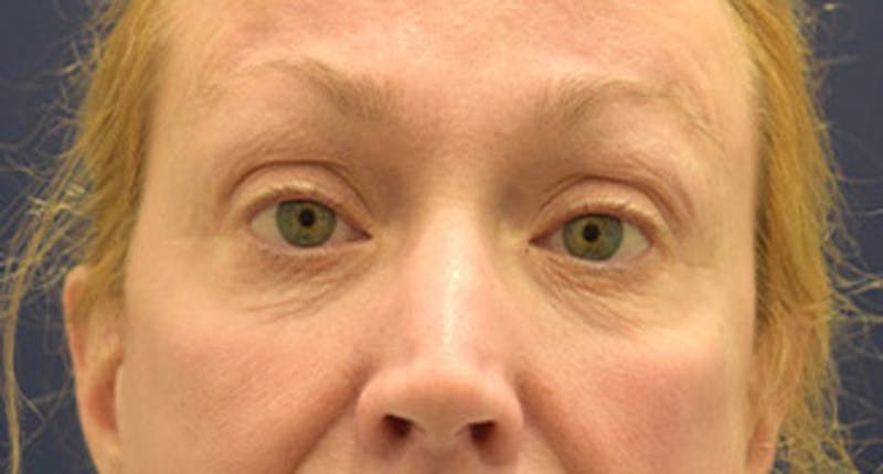 Eyelid Surgery Before & After Gallery - Patient 174146453 - Image 1